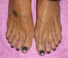 Ongles Pieds
