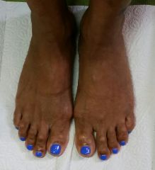 Ongles Pieds