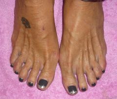 Ongles Pieds